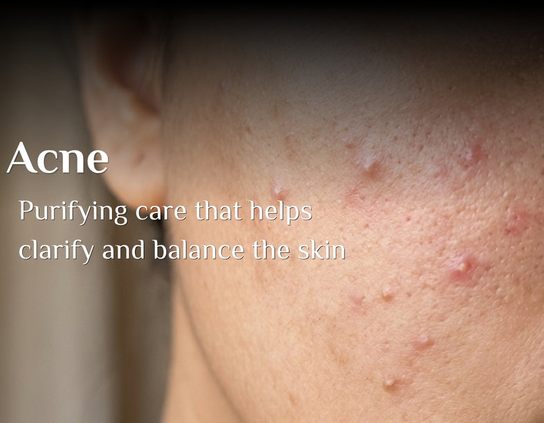 Acne 