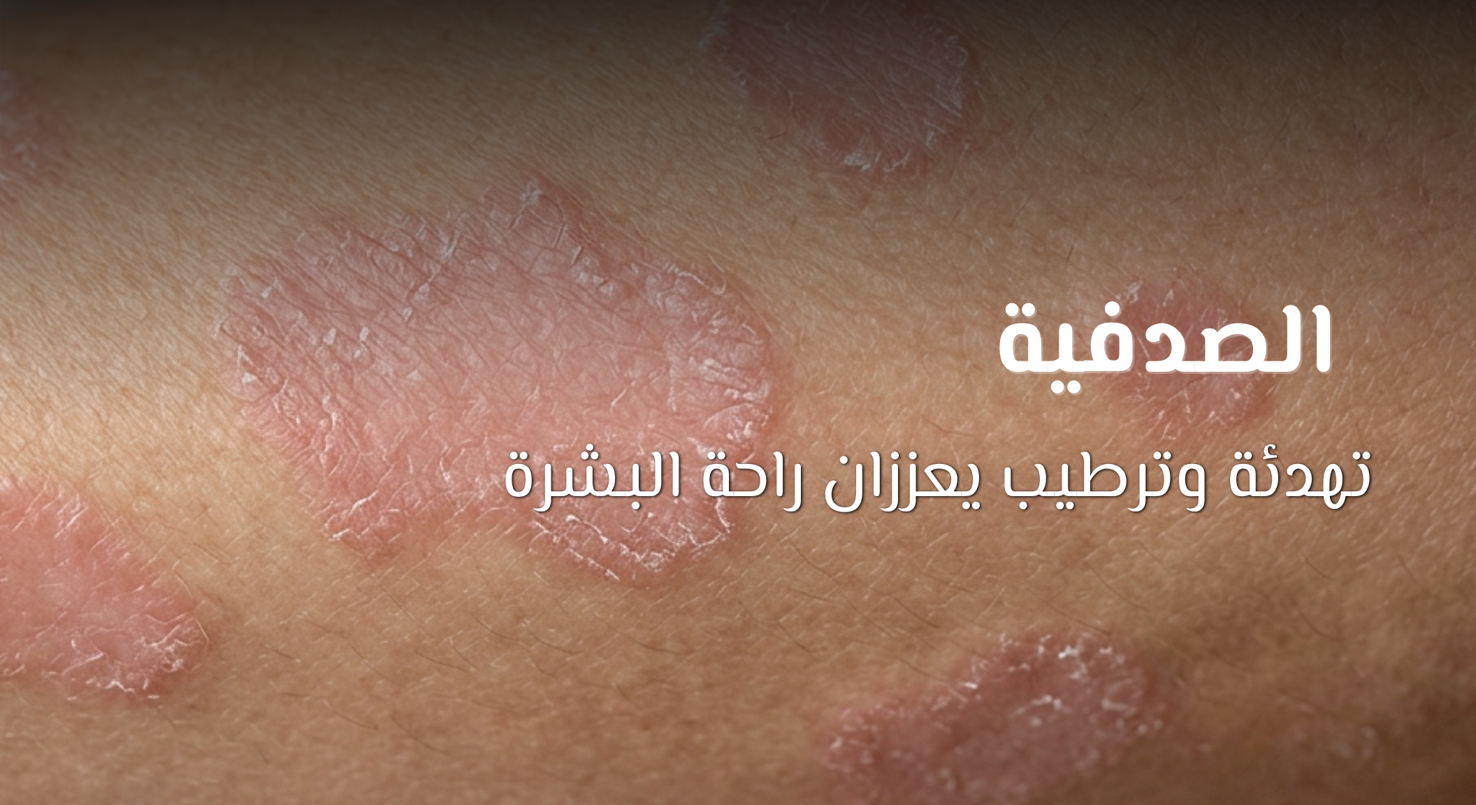 How dead sea help in Psoriasis web