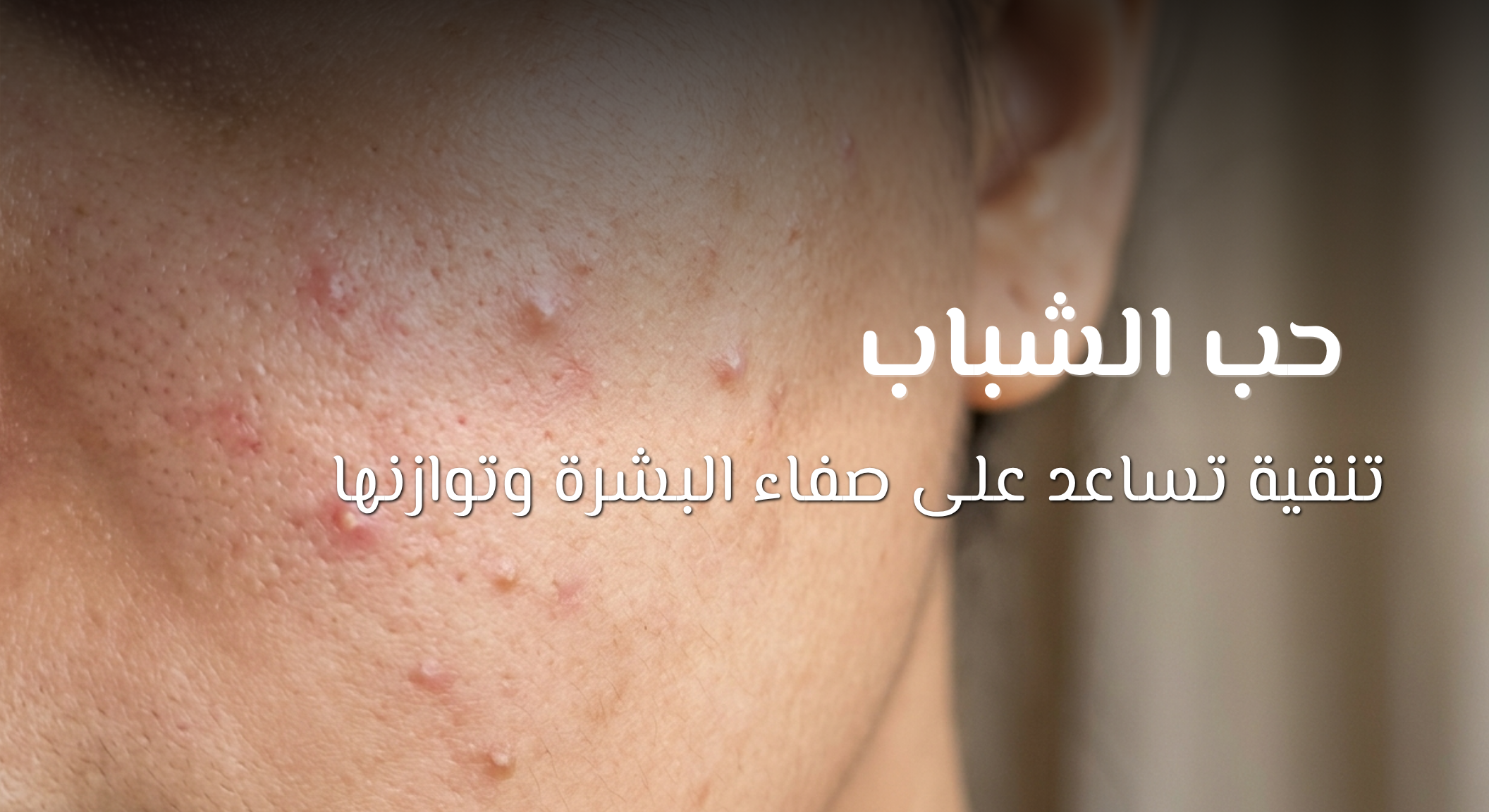 How dead sea help in acne web