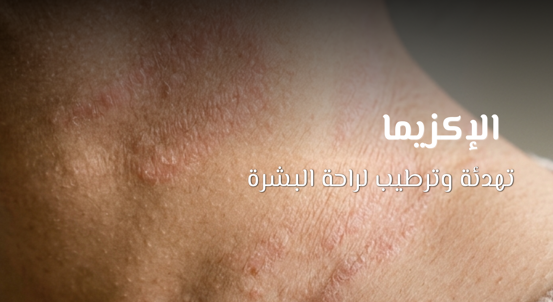How dead sea help in eczema web